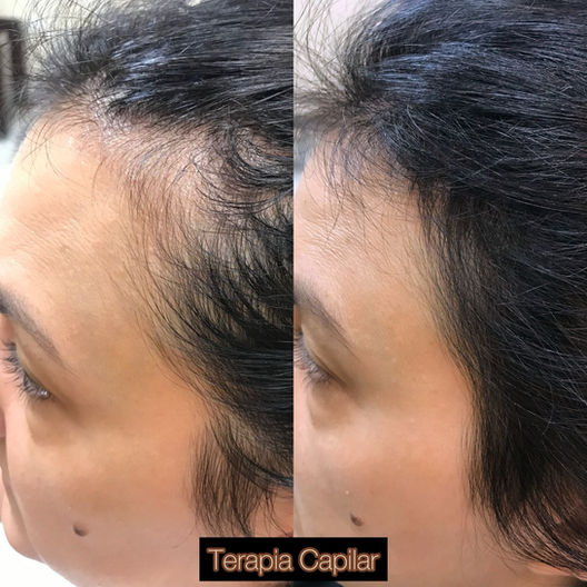 Antes e depois de tratamento capilar