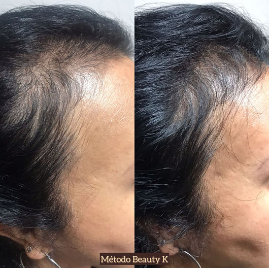 Antes e depois de tratamento capilar